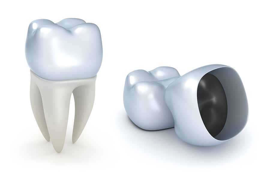 A Comprehensive Guide to Dental Crowns: Restoring Strength and Aesthetics to Your Smile