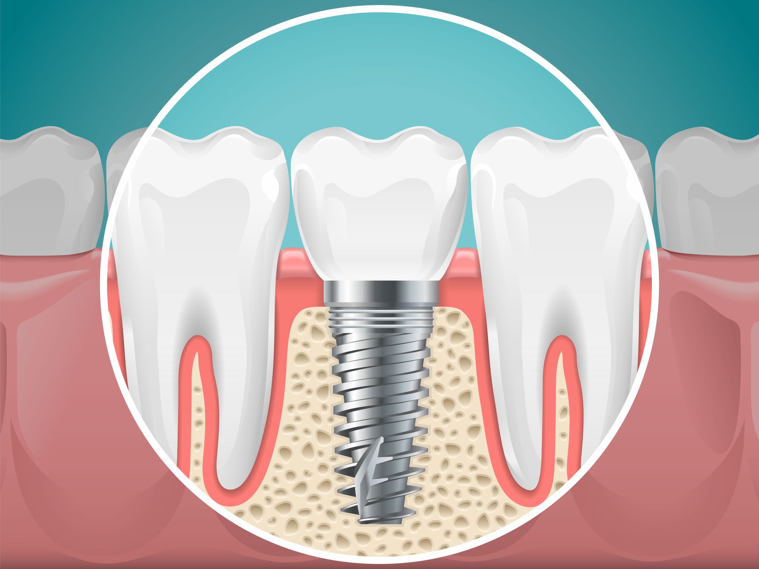 Restore Your Smile with Dental Implants in Flat Rock, NC