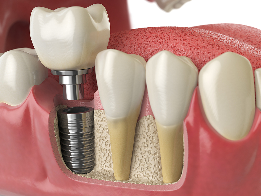 The Ultimate Guide to Dental Implants: A Permanent Solution for Missing Teeth