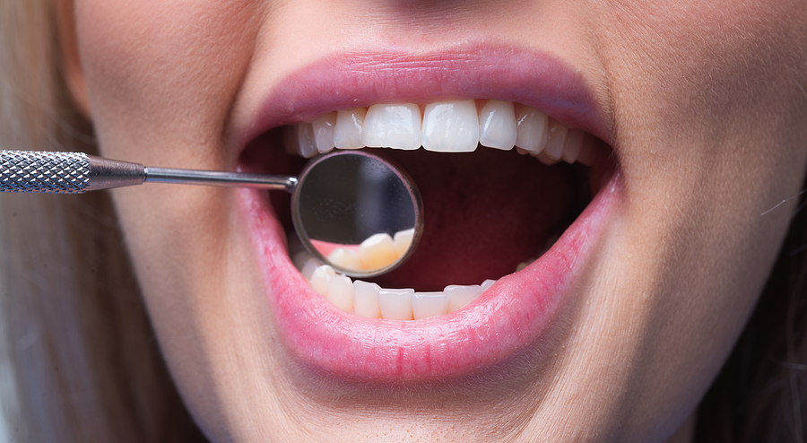 Why Dental Implants Are the Closest Thing to Natural Teeth