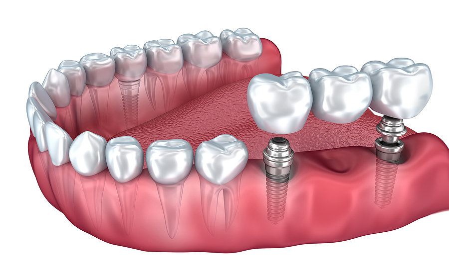 A Complete Guide to Dental Implants: Restoring Your Smile with Confidence