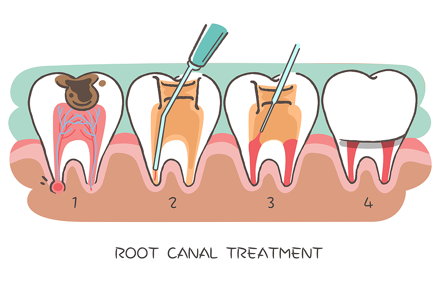 Understanding Root Canals: A Guide to Treatment and Recovery in Flat Rock, NC