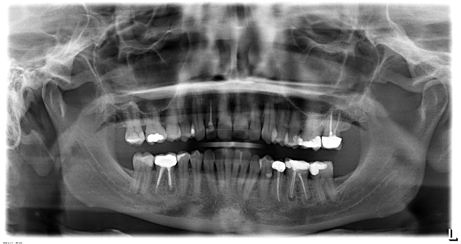 How Modern Technology Makes Root Canals Quick and Painless 